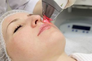Processus de rajeunissement de la peau du visage avec laser fractionné