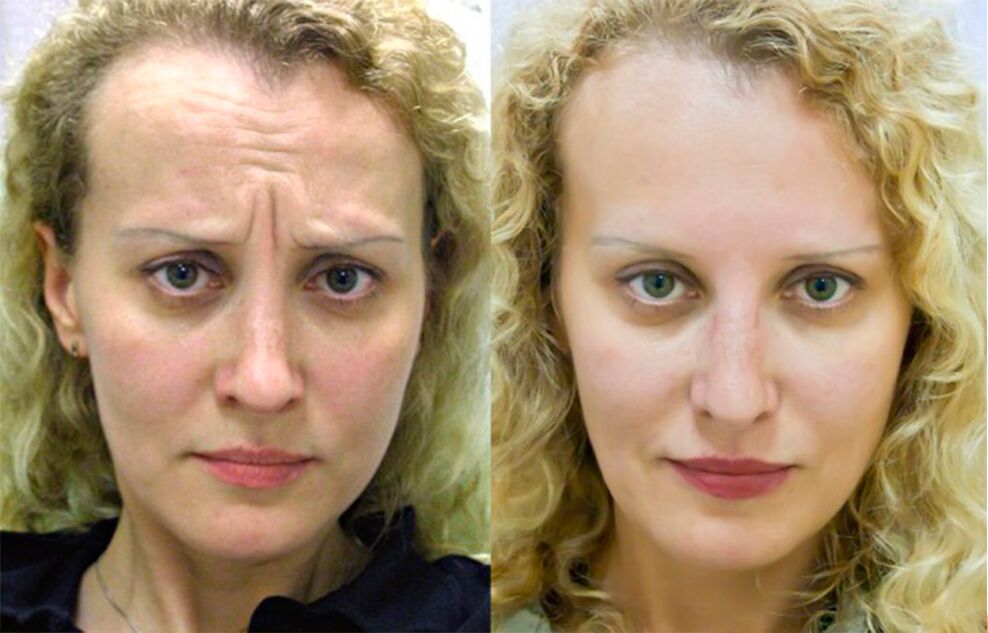 avant et après l'utilisation du masseur pour le rajeunissement ltza photo 1