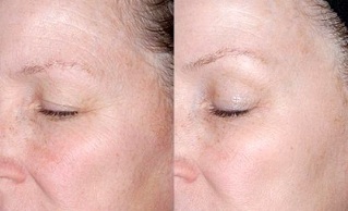 rajeunissement de la peau autour des yeux photos avant et après