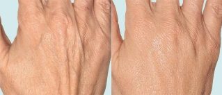 Peau des mains avant et après la thérapie fractionnée